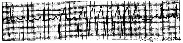 心电图详细图解 心电