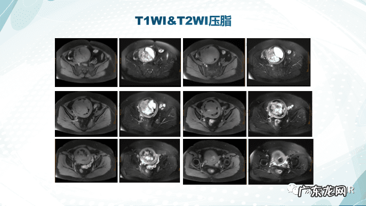 子宫内膜间质肉瘤病理 子宫内膜间质肉瘤分期标准