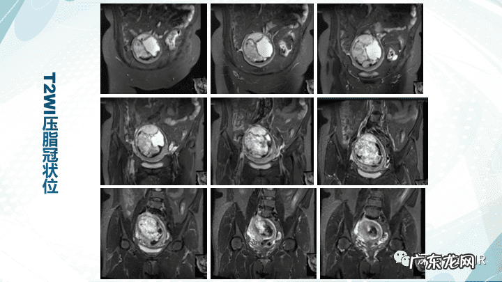 子宫内膜间质肉瘤病理 子宫内膜间质肉瘤分期标准