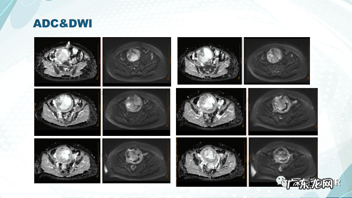 子宫内膜间质肉瘤病理 子宫内膜间质肉瘤分期标准