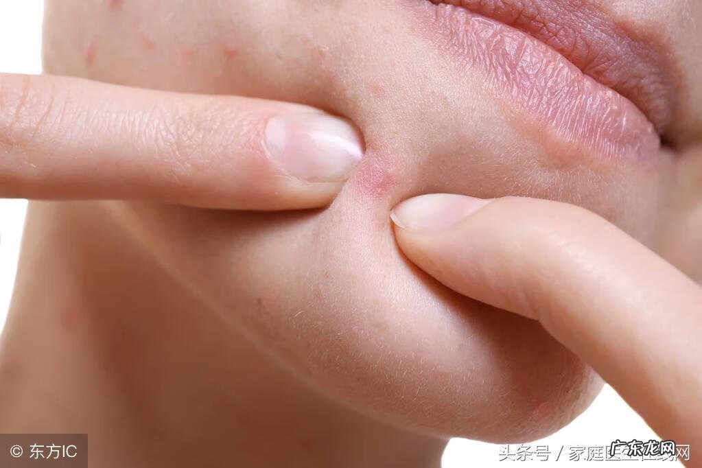 痤疮怎么清洁皮肤 皮肤痤疮