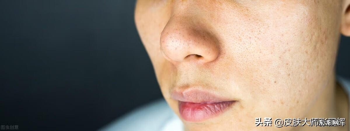 皮肤毛孔粗大 面部皮肤毛孔粗大怎么办啊