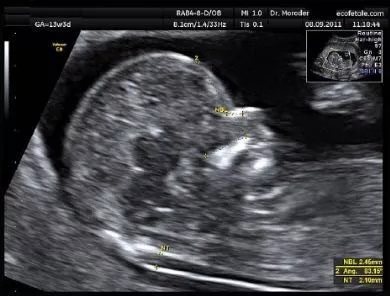 nt检查什么项目 nt是检查什么