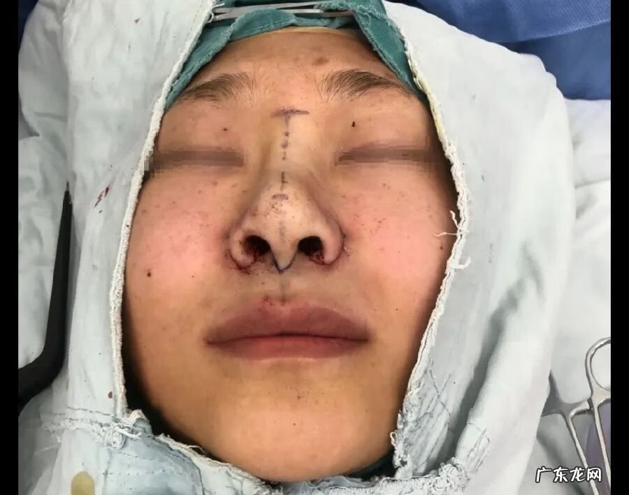 鼻孔可以变小吗 鼻孔变小的方法