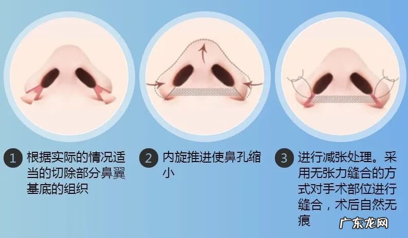 鼻孔可以变小吗 鼻孔变小的方法