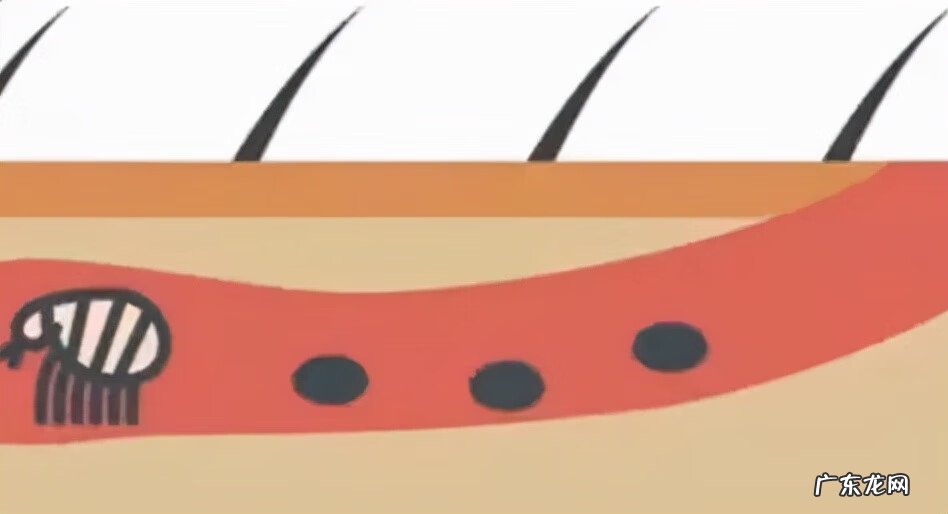 疳疮图片 疥疮图片