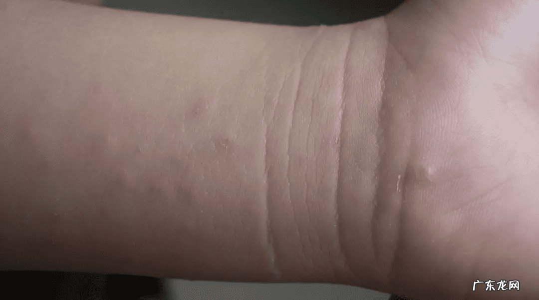 疳疮图片 疥疮图片