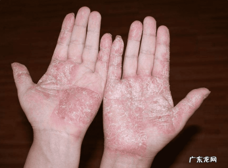 手脚脱皮什么原因 手脚脱皮是什么原因