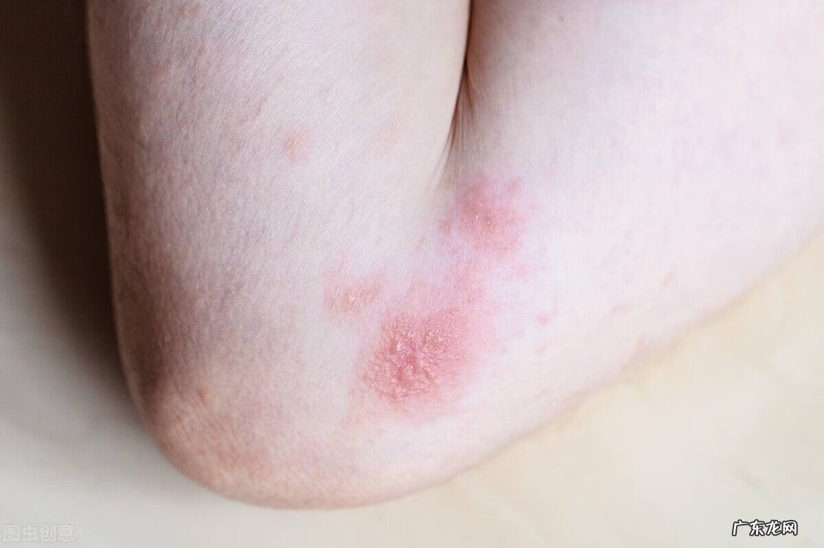 hiv其实很难传染 hiv症状表现