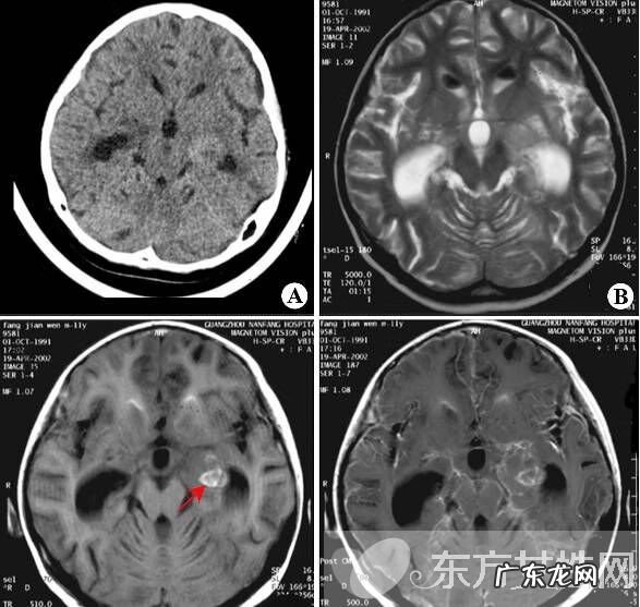 成人脑膜炎的症状表现 急性脑膜炎的早期症状