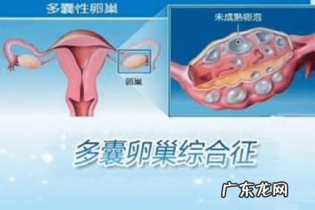 多囊卵巢怎么治疗最好最有效 多囊卵巢综合症怎么治疗有效