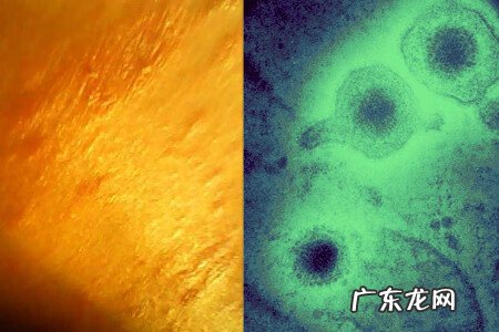 单纯疱疹怎么治疗 怎么治疗疱疹病