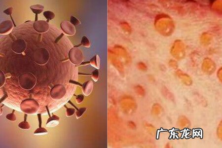 单纯疱疹怎么治疗 怎么治疗疱疹病