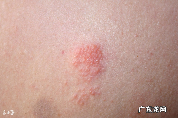 单纯疱疹怎么治疗 怎么治疗疱疹病