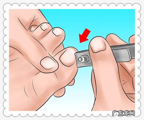 甲沟炎的家庭处理方法 甲沟炎怎么处理