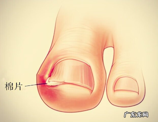 甲沟炎的家庭处理方法 甲沟炎怎么处理