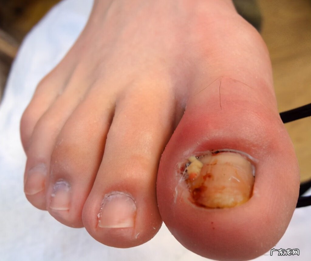 甲沟炎的家庭处理方法 甲沟炎怎么处理