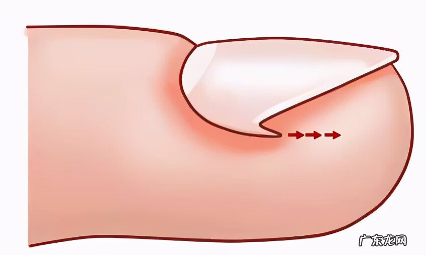 甲沟炎的家庭处理方法 甲沟炎怎么处理