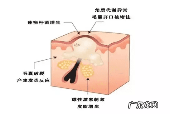 青春期痘痘 青春痘图片