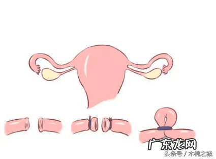 取环相当于几级疼痛 取环疼吗什么感觉