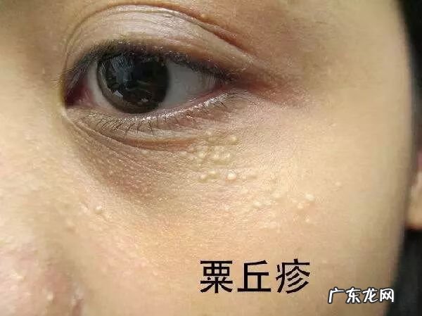 上眼皮长出一个凸起的肉疙瘩 眼皮上长了个小疙瘩是怎么回事图片