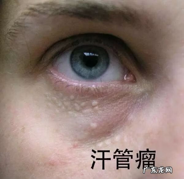 上眼皮长出一个凸起的肉疙瘩 眼皮上长了个小疙瘩是怎么回事图片