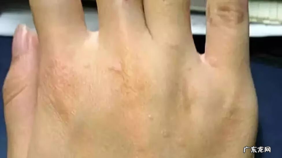 上眼皮长出一个凸起的肉疙瘩 眼皮上长了个小疙瘩是怎么回事图片