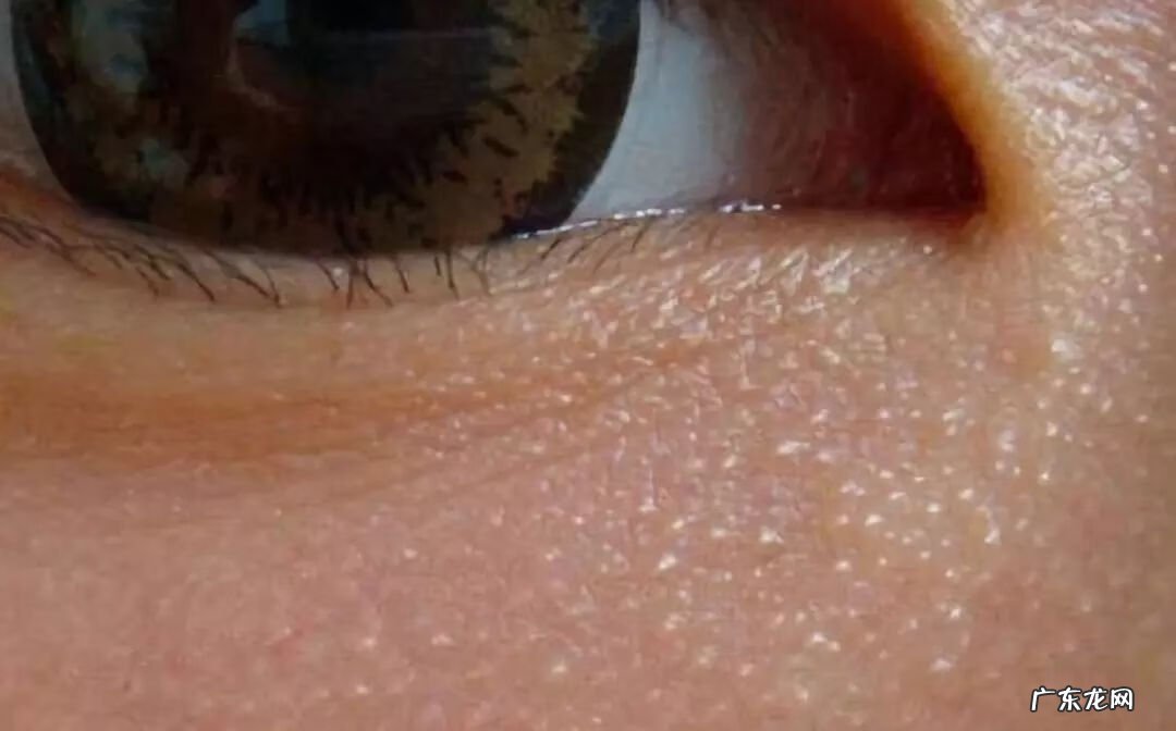 上眼皮长出一个凸起的肉疙瘩 眼皮上长了个小疙瘩是怎么回事图片