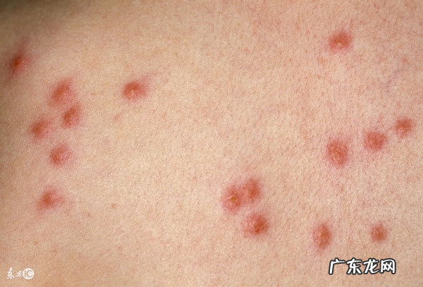 丘疹性荨麻疹的原因 丘疹性荨麻疹是传染病吗