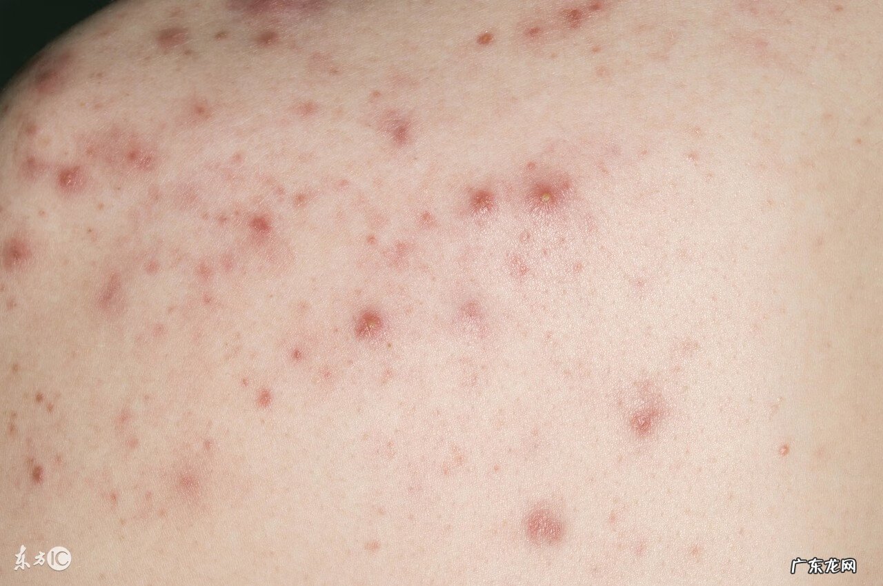 丘疹性荨麻疹的原因 丘疹性荨麻疹是传染病吗