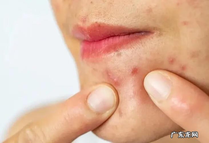 嘴巴周围长痘的原因 嘴巴周围长痘痘用什么最有效