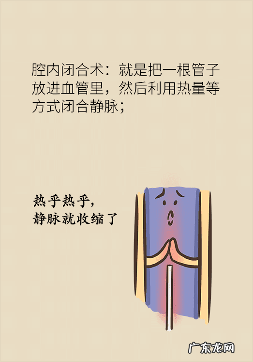 我自己治好了静脉曲张 静脉曲张怎么办?