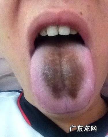 舌头有点发黑是怎么回事 舌头发黑是什么原因引起