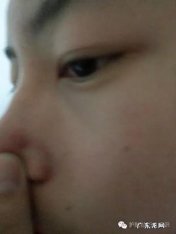 鼻子长了好多小痘痘怎么回事 鼻子长痘痘是什么原因引起的