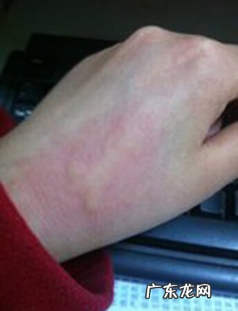 慢性荨麻疹初期症状 慢性荨麻疹症状有哪些