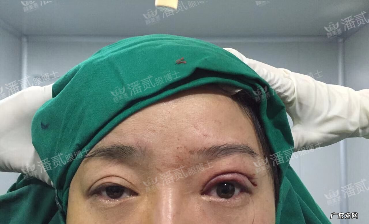 割双眼皮风水讲究 提拉眼皮会影响风水么