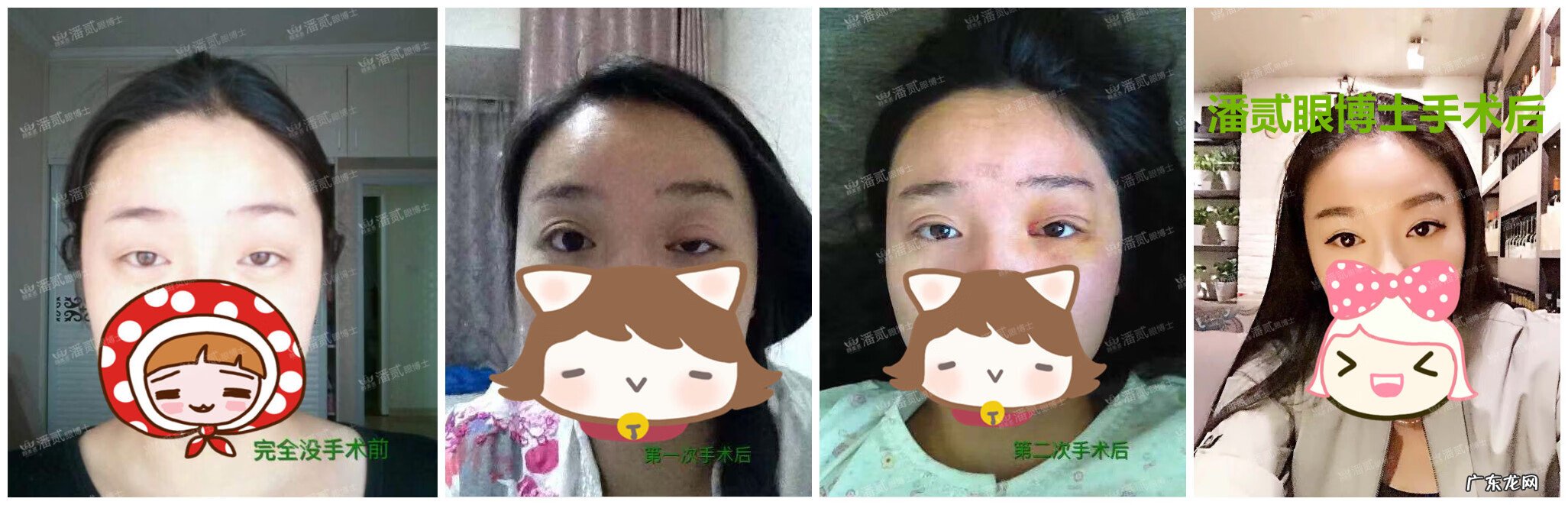 割双眼皮风水讲究 提拉眼皮会影响风水么