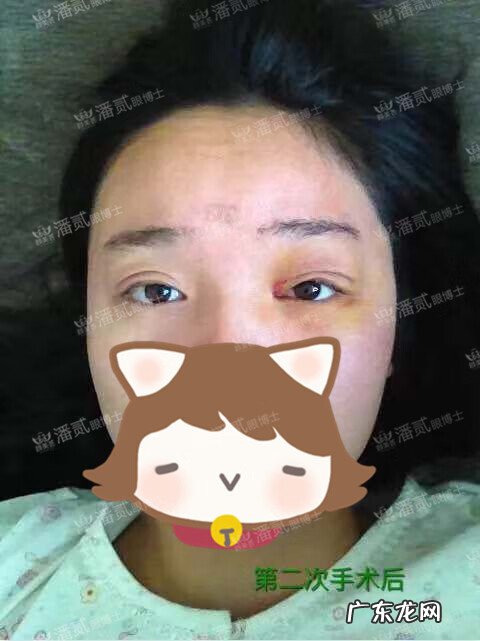 割双眼皮风水讲究 提拉眼皮会影响风水么