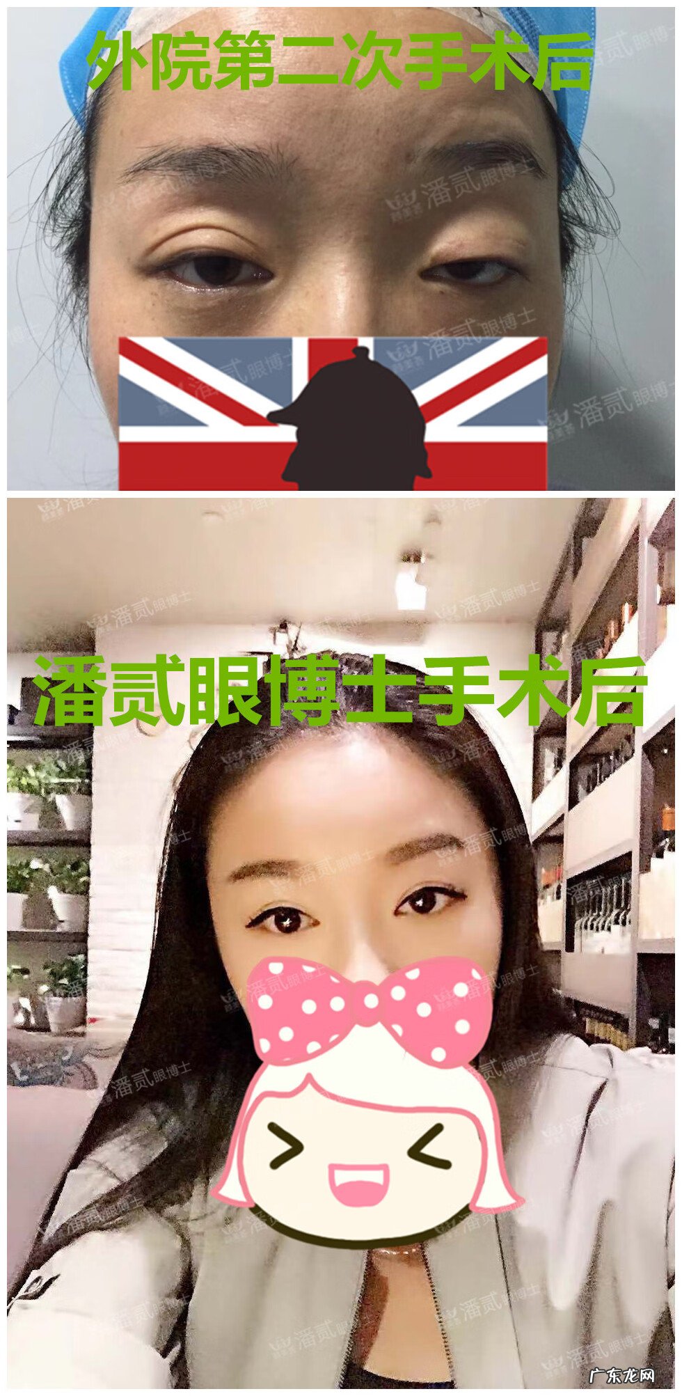 割双眼皮风水讲究 提拉眼皮会影响风水么