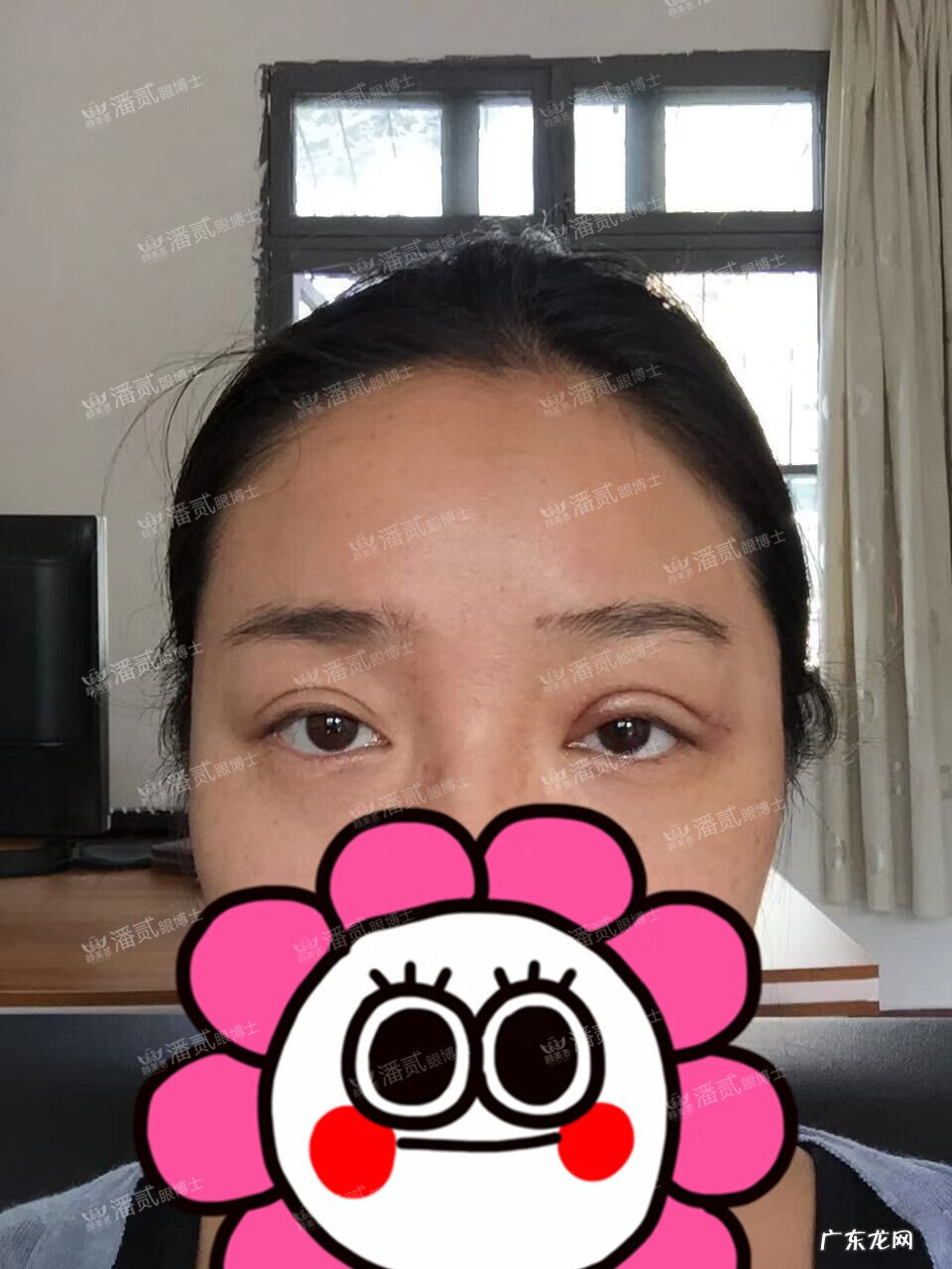 割双眼皮风水讲究 提拉眼皮会影响风水么