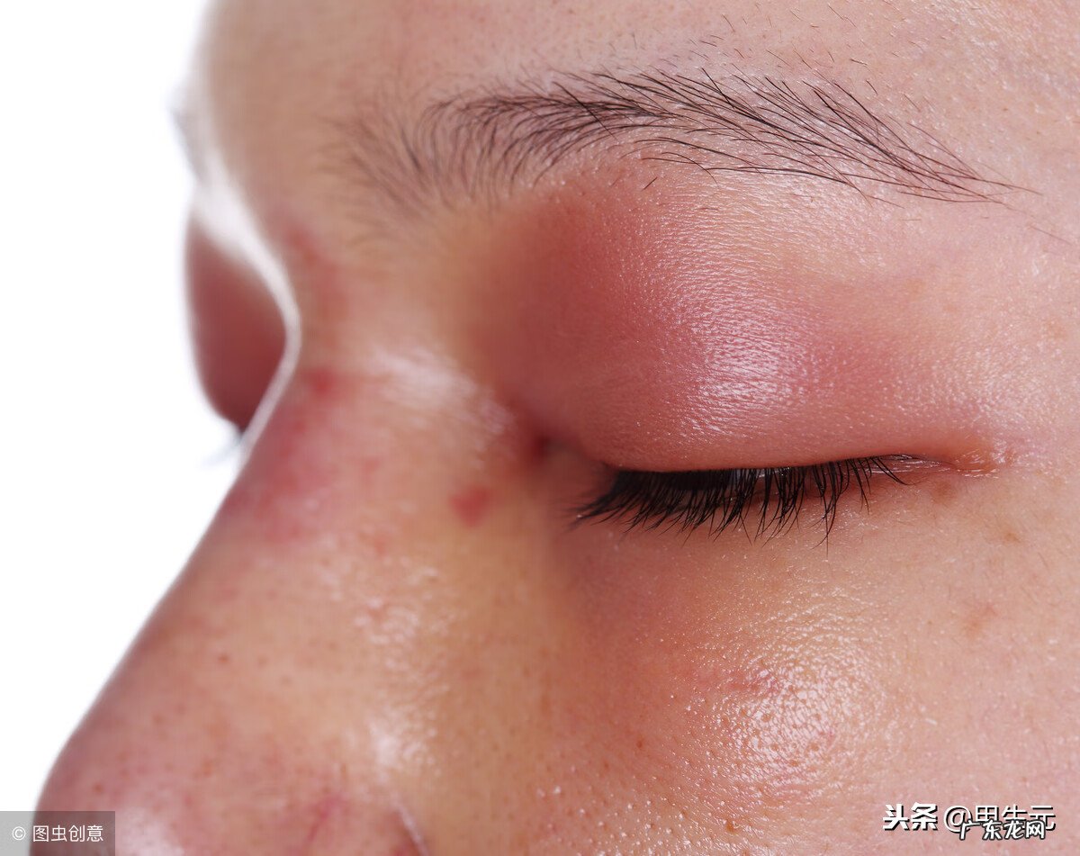 一只眼皮肿是怎么回事 上眼皮肿是怎么回事