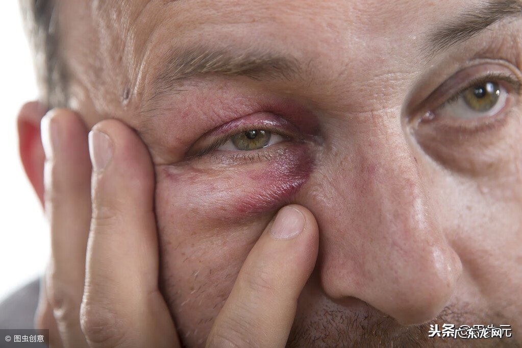 一只眼皮肿是怎么回事 上眼皮肿是怎么回事