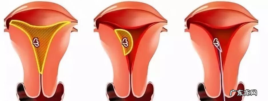 无痛人流原理过程图 什么是无痛人流?