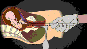 无痛人流原理过程图 什么是无痛人流?