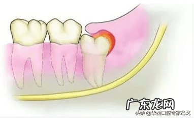 牙齿疼的原因是什么 牙齿疼痛是怎么回事