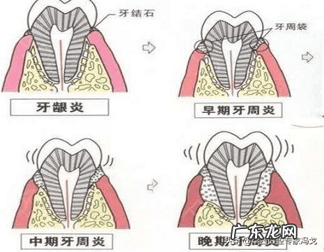 牙齿疼的原因是什么 牙齿疼痛是怎么回事