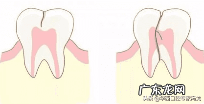 牙齿疼的原因是什么 牙齿疼痛是怎么回事