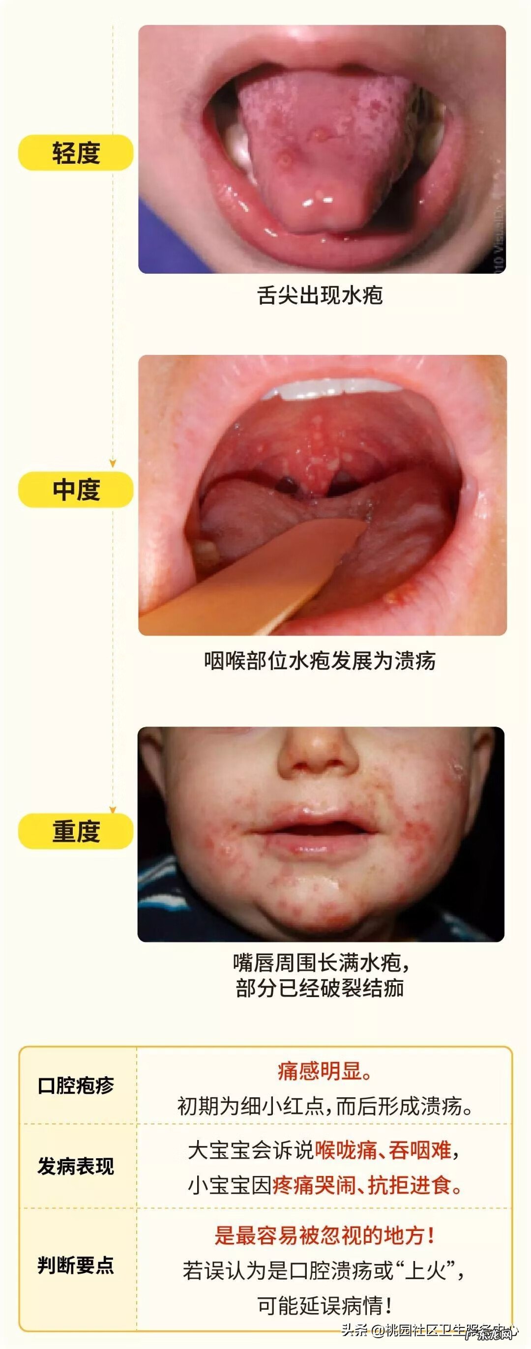手足口开始好的征兆 手足口病