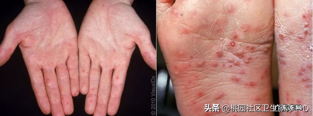 手足口开始好的征兆 手足口病