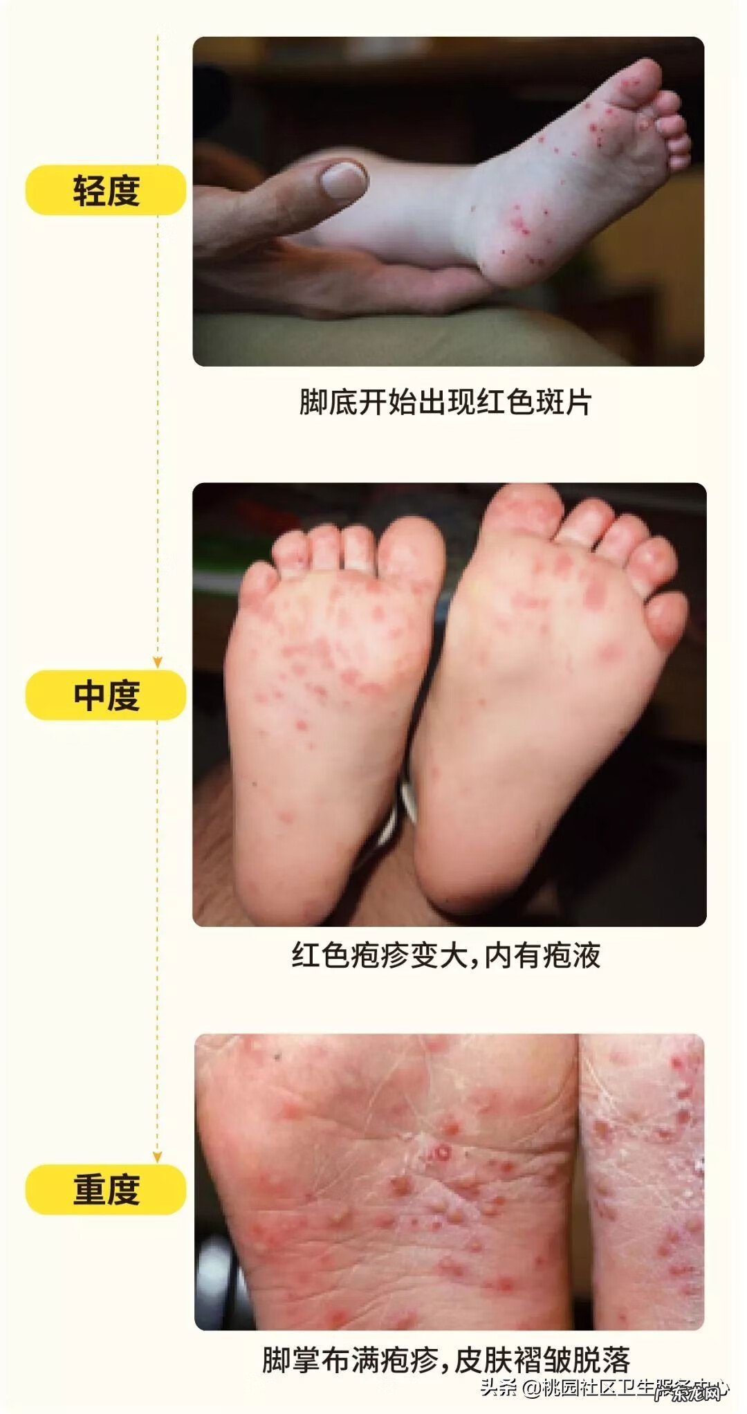 手足口开始好的征兆 手足口病